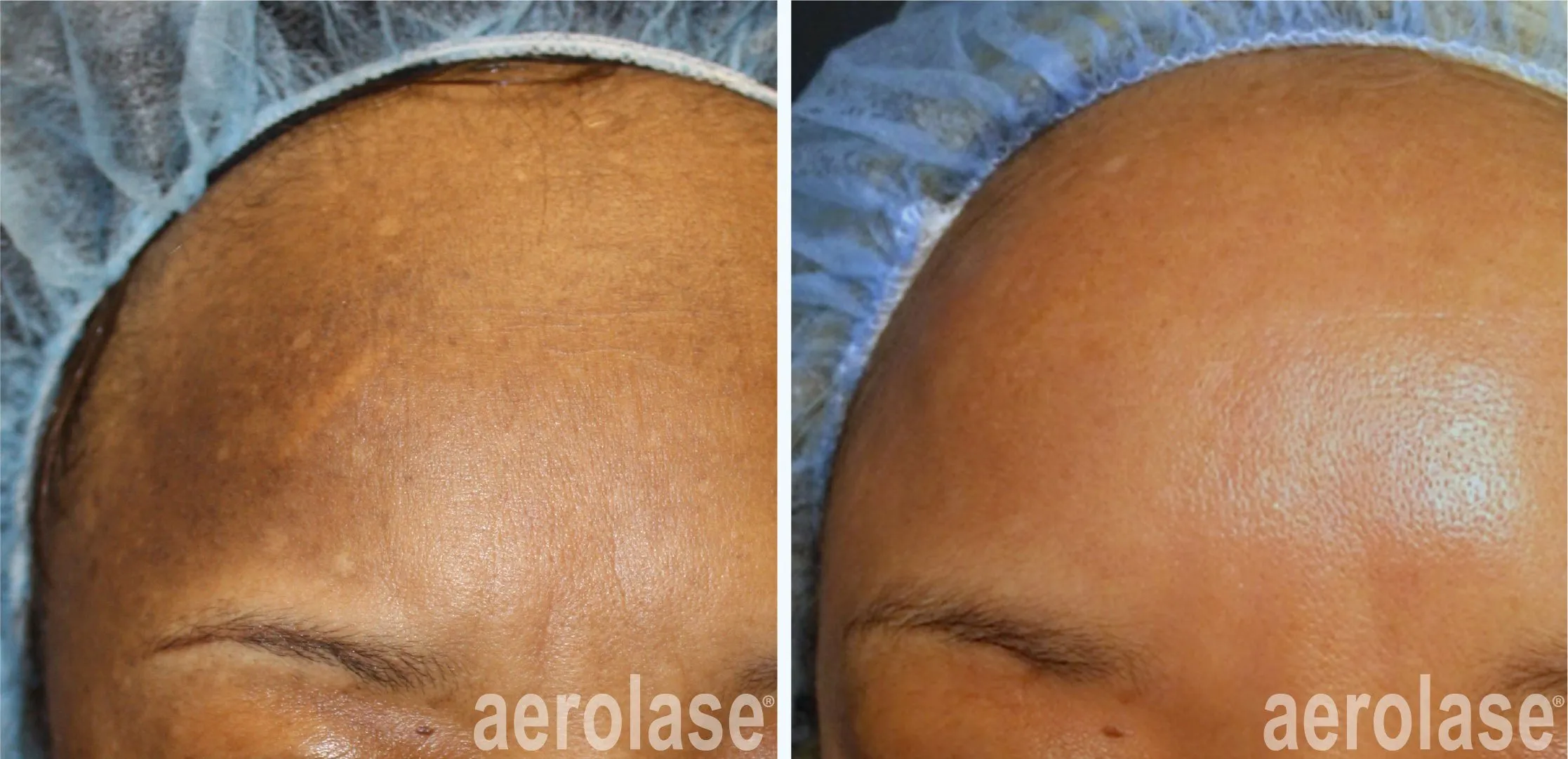 hyperpigmentation from laser treatment