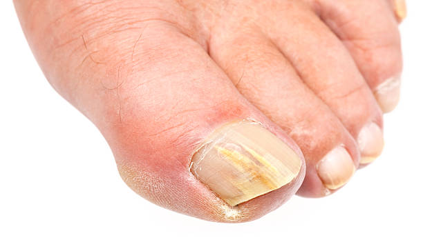 laser for nail fungus