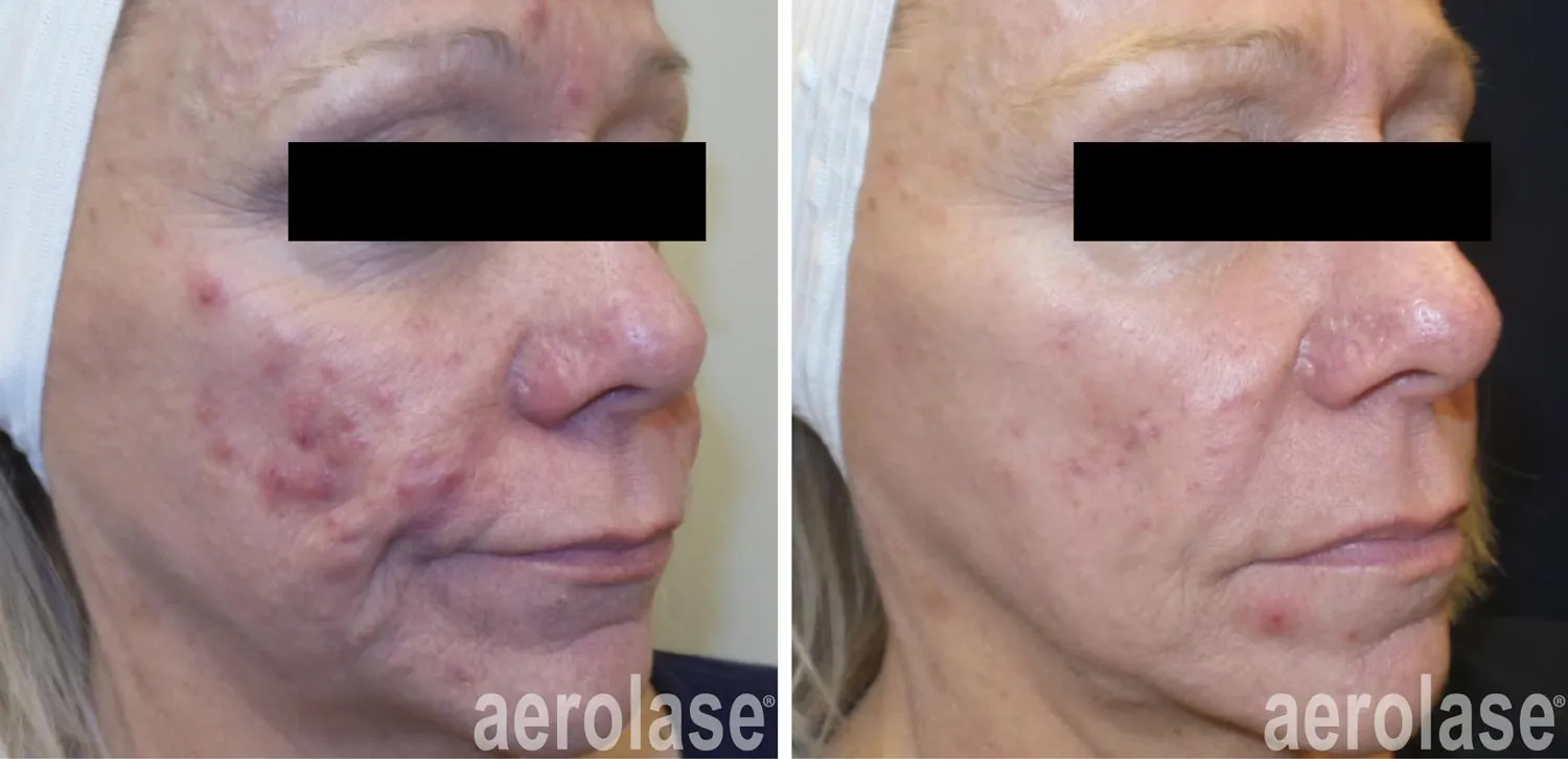 acne scars before and after 1