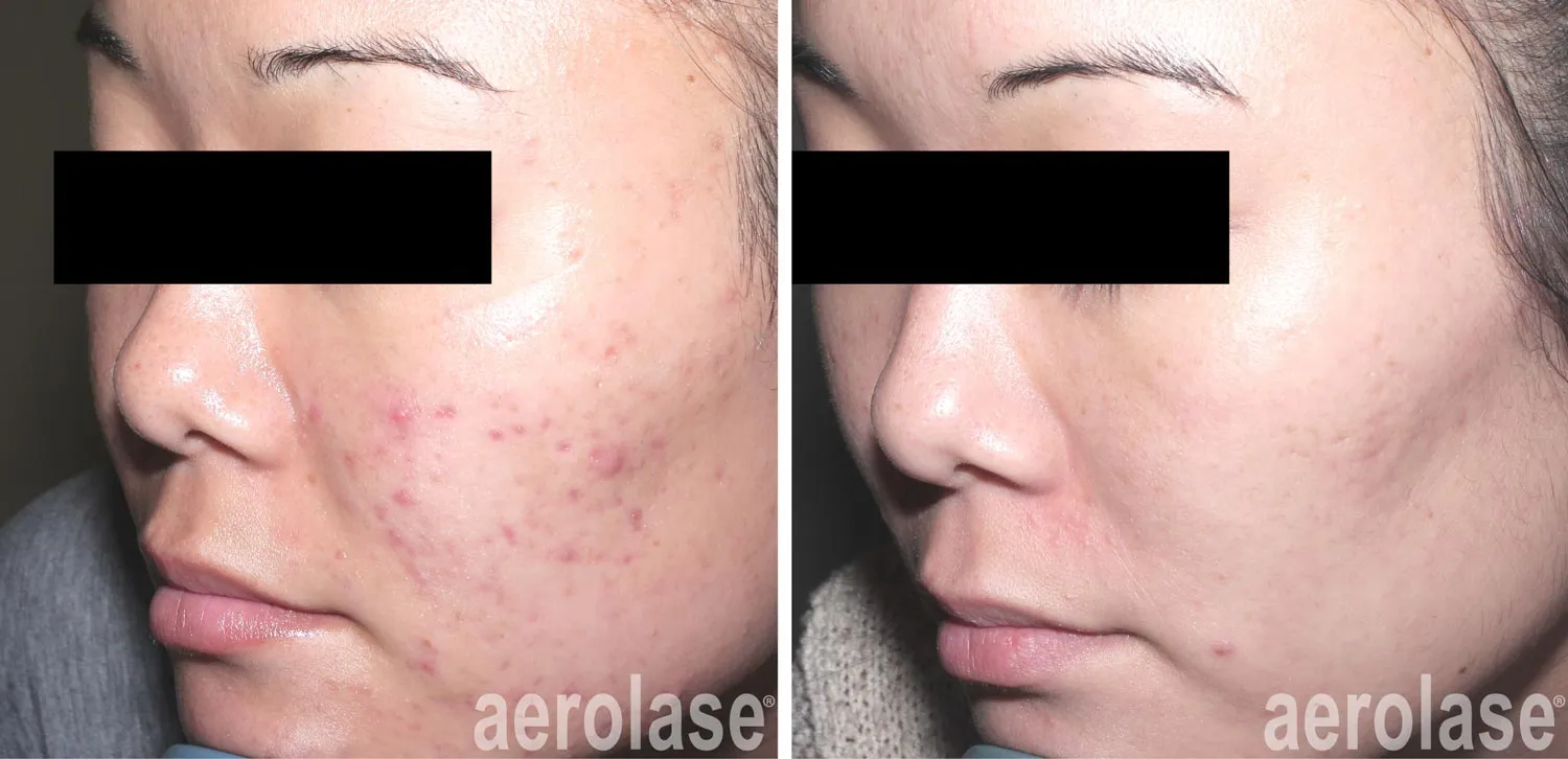 acne scars 2