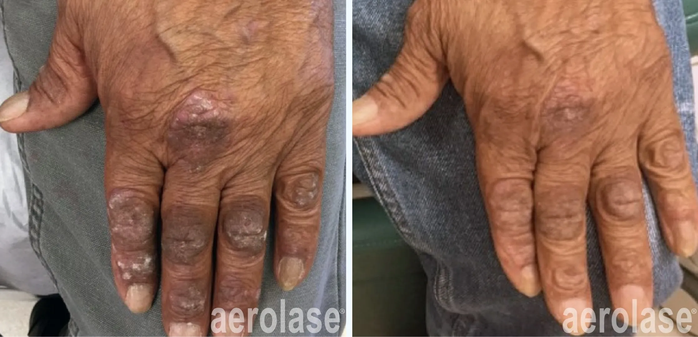 autoimmune-diseases-psoriasis-mark-nestor-before-and-after