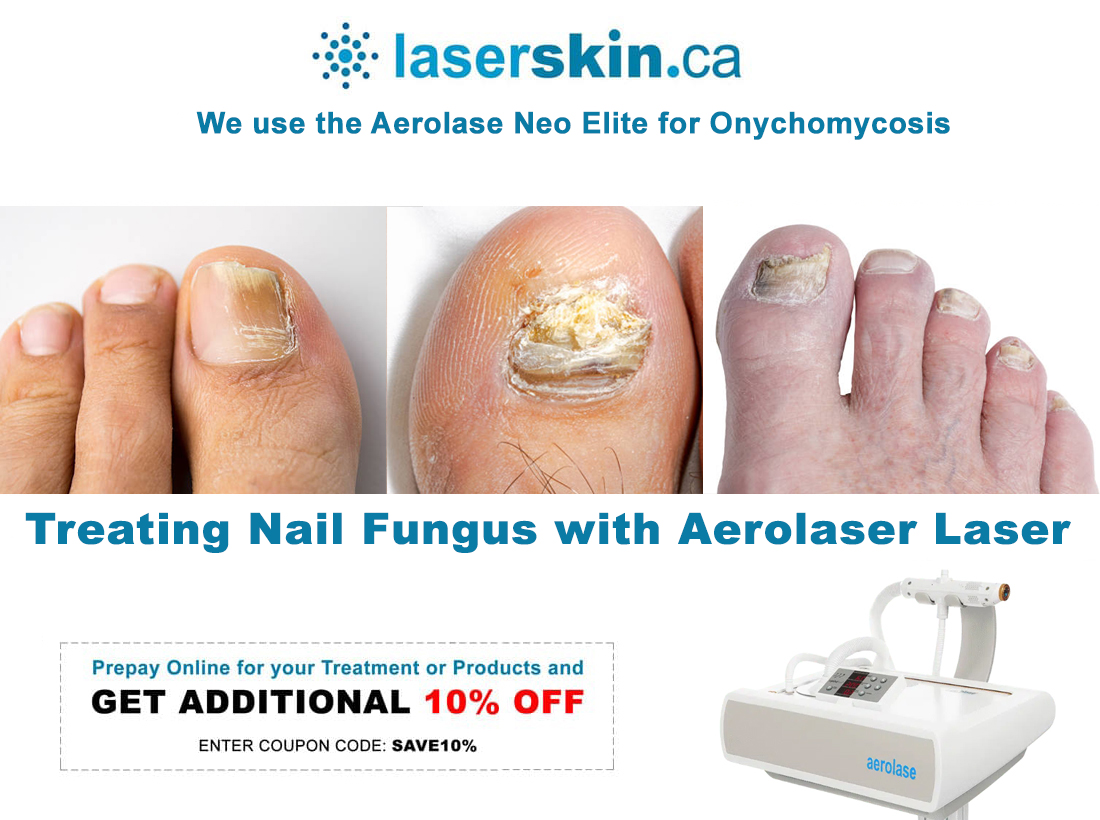 Nail Fungus Treatment | Green Bay | Wisconsin Laser Therapy