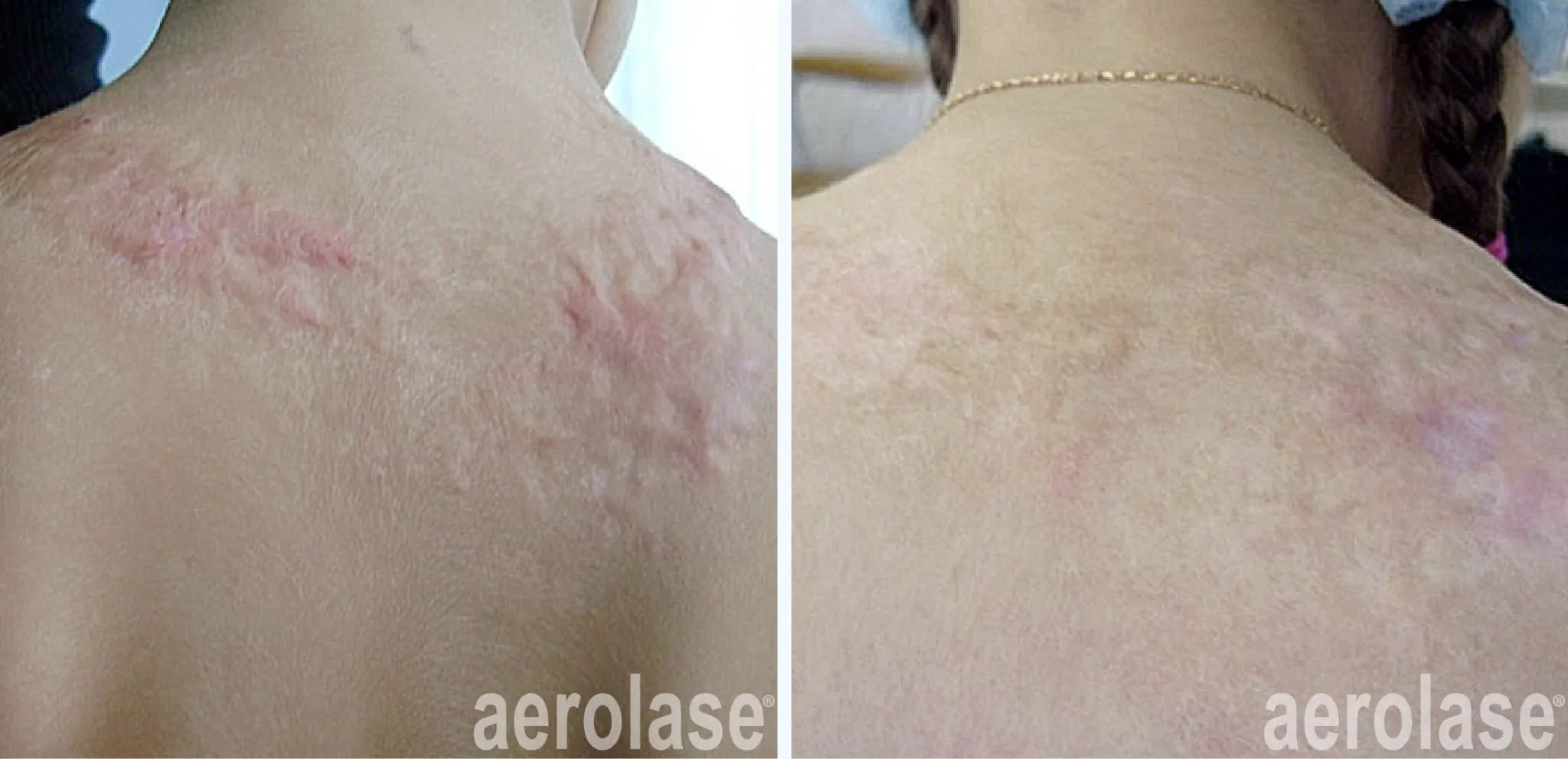 burn-scar-drzoyaklimova-before-and-after