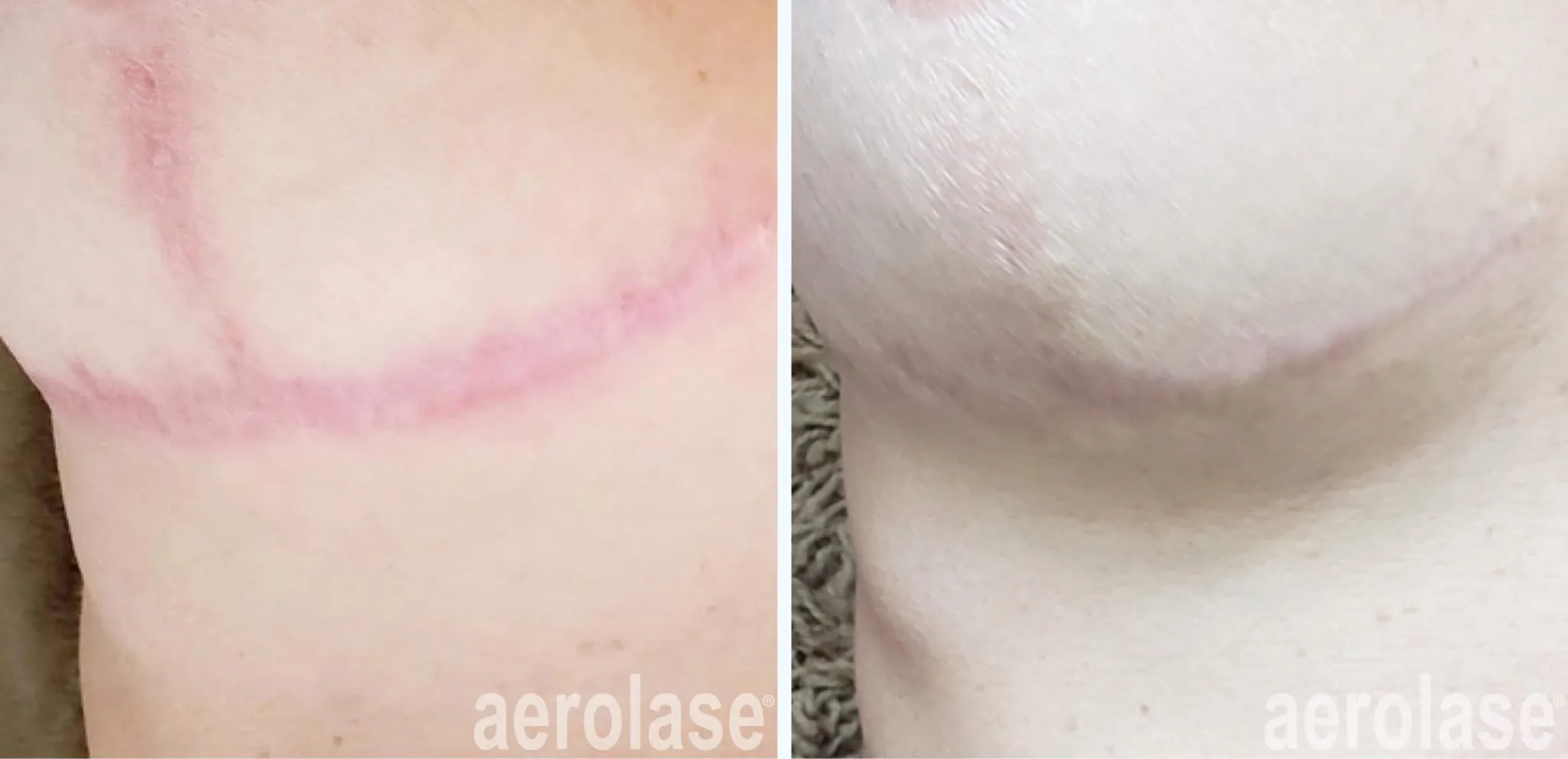 post-surgical-scar-2-before-and-after