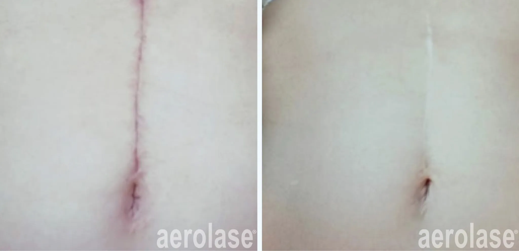 post-surgical-scar-before-and-after