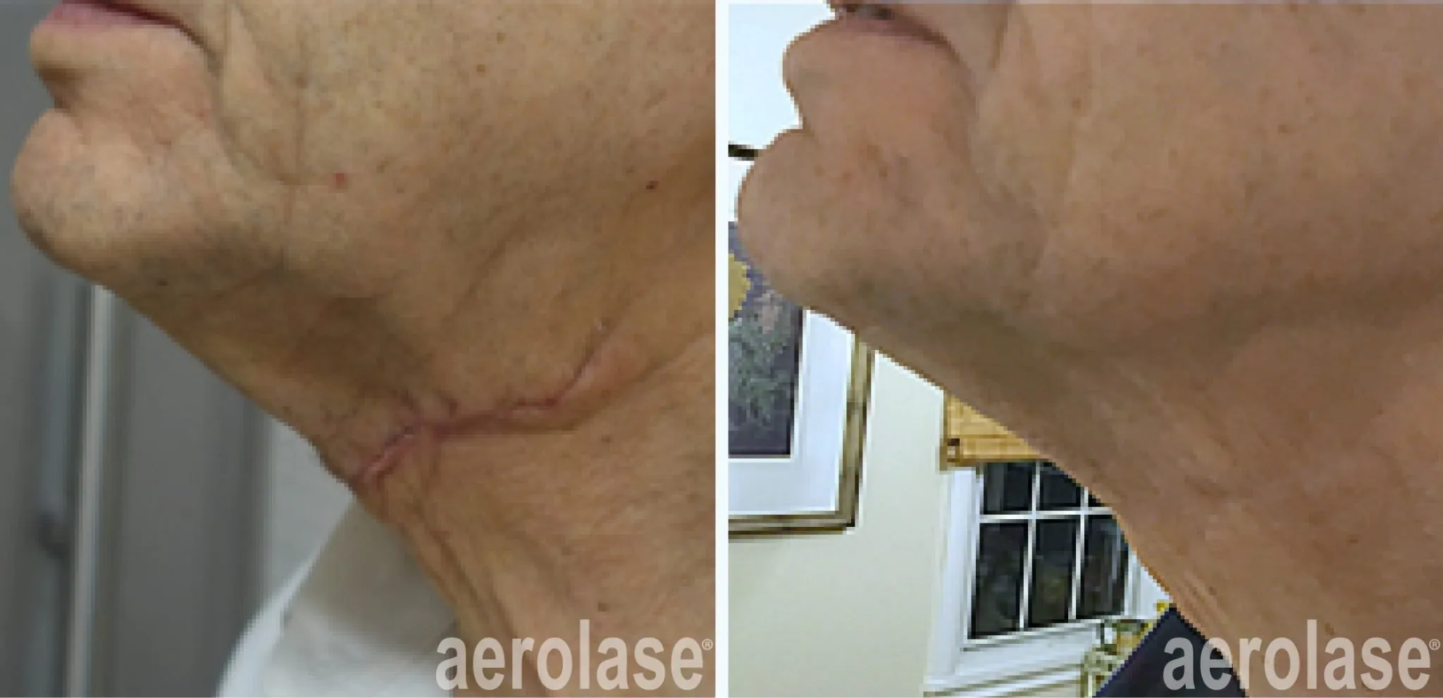 surgical-scar-before-and-after
