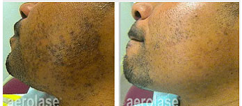 Pseudofolliculitis Barbae treatment - ingrown hair