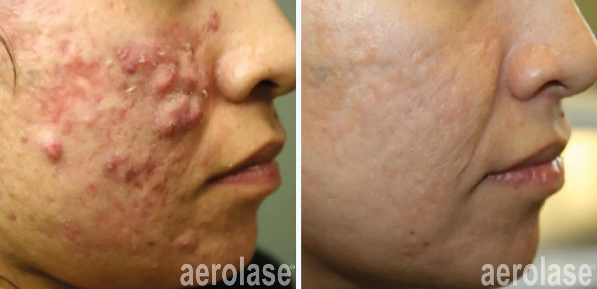 Innovations in Dermatology: Role of Aerolase Laser in Managing Active Acne