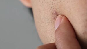 how to get rid of razor bumps