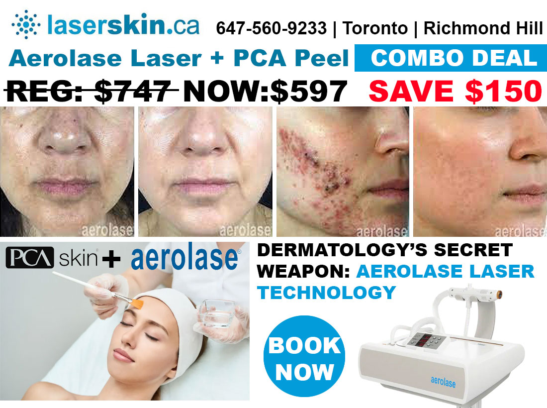 laser for acne scars