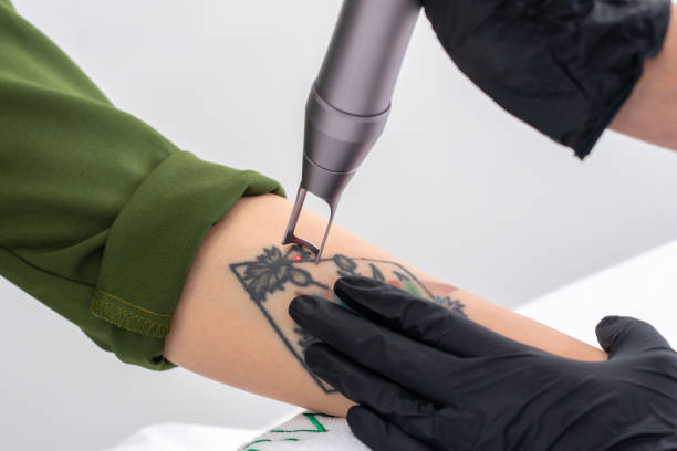 Tattoo Removal Cost: A Comprehensive Guide Featuring Laser Skin Clinics in Toronto and Richmond Hill