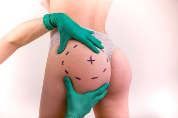 Sculptra Butt Lift - , Laser Hair Removal And Skin Care Clinic  Toronto