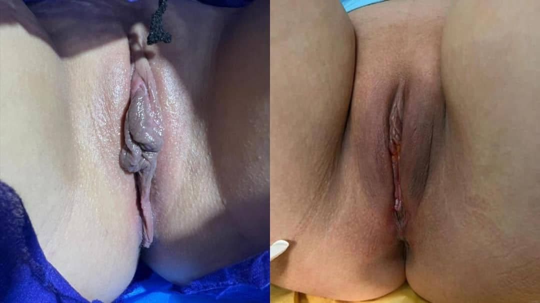 vaginal rejuvenation - labiaplasty - o shot toronto