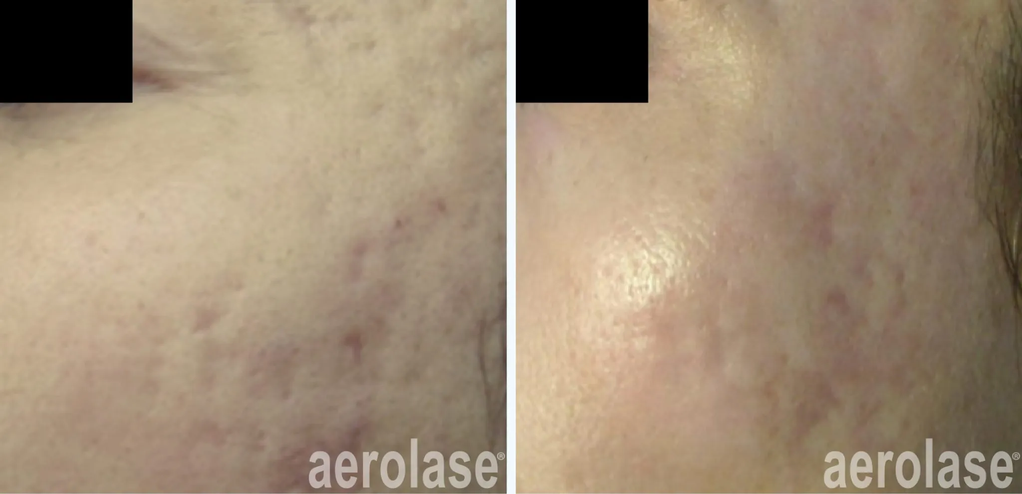 111acne-scars-viktor-moiseey-before-and-after-2048x991