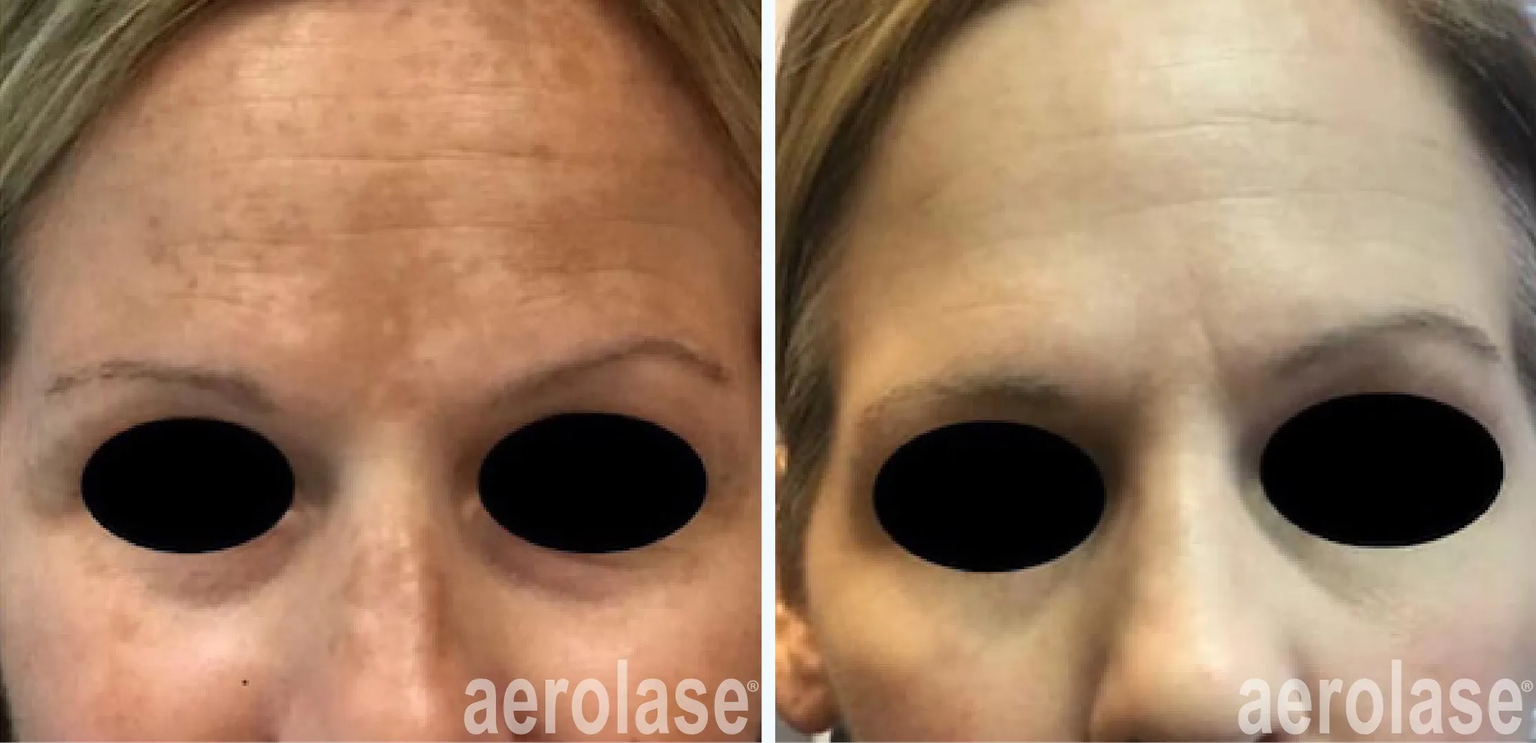 zx111melasma-2-cheryl-burgess-before-and-after