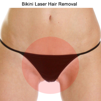 Bikini laser hair removal Toronto