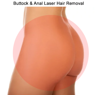 Buttock and Anal laser hair removal Toronto