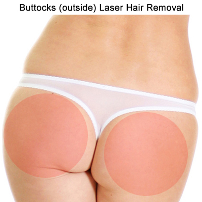 Buttocks laser hair removal Toronto
