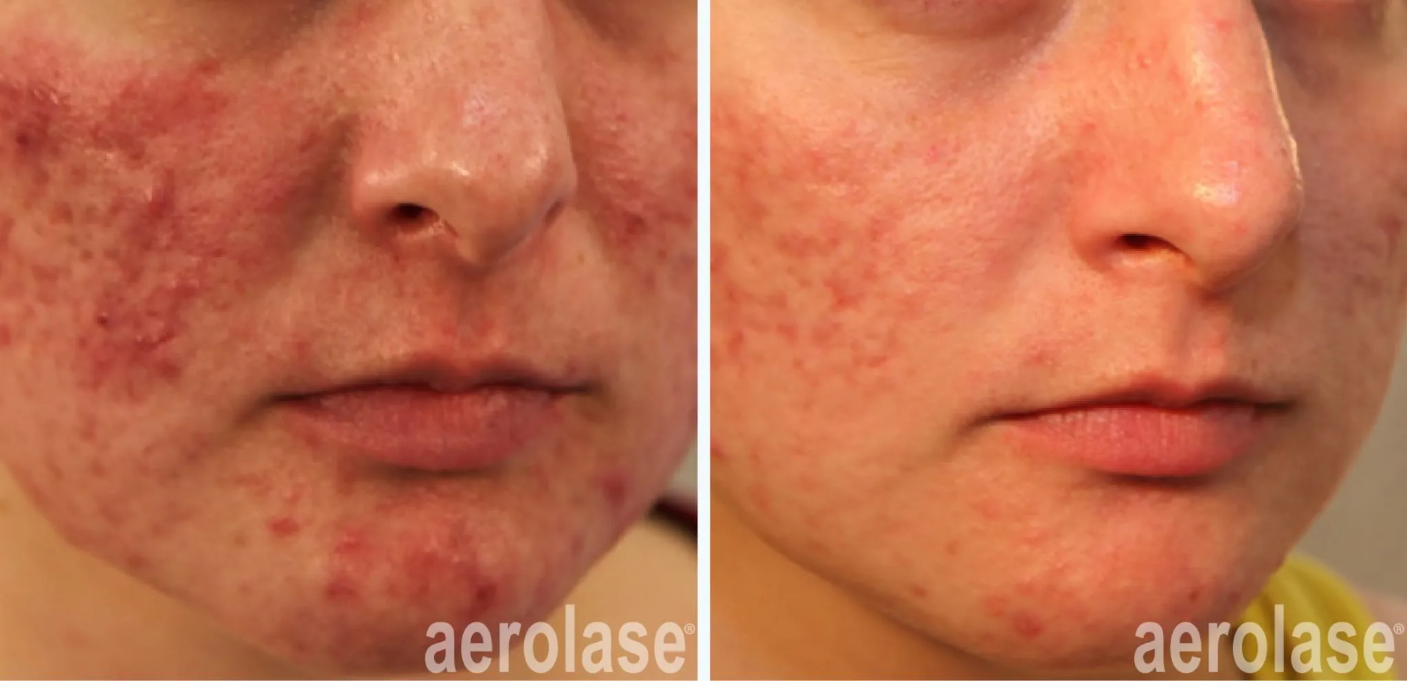 acne-acne-redness-natalia-geraskova-before-and-after