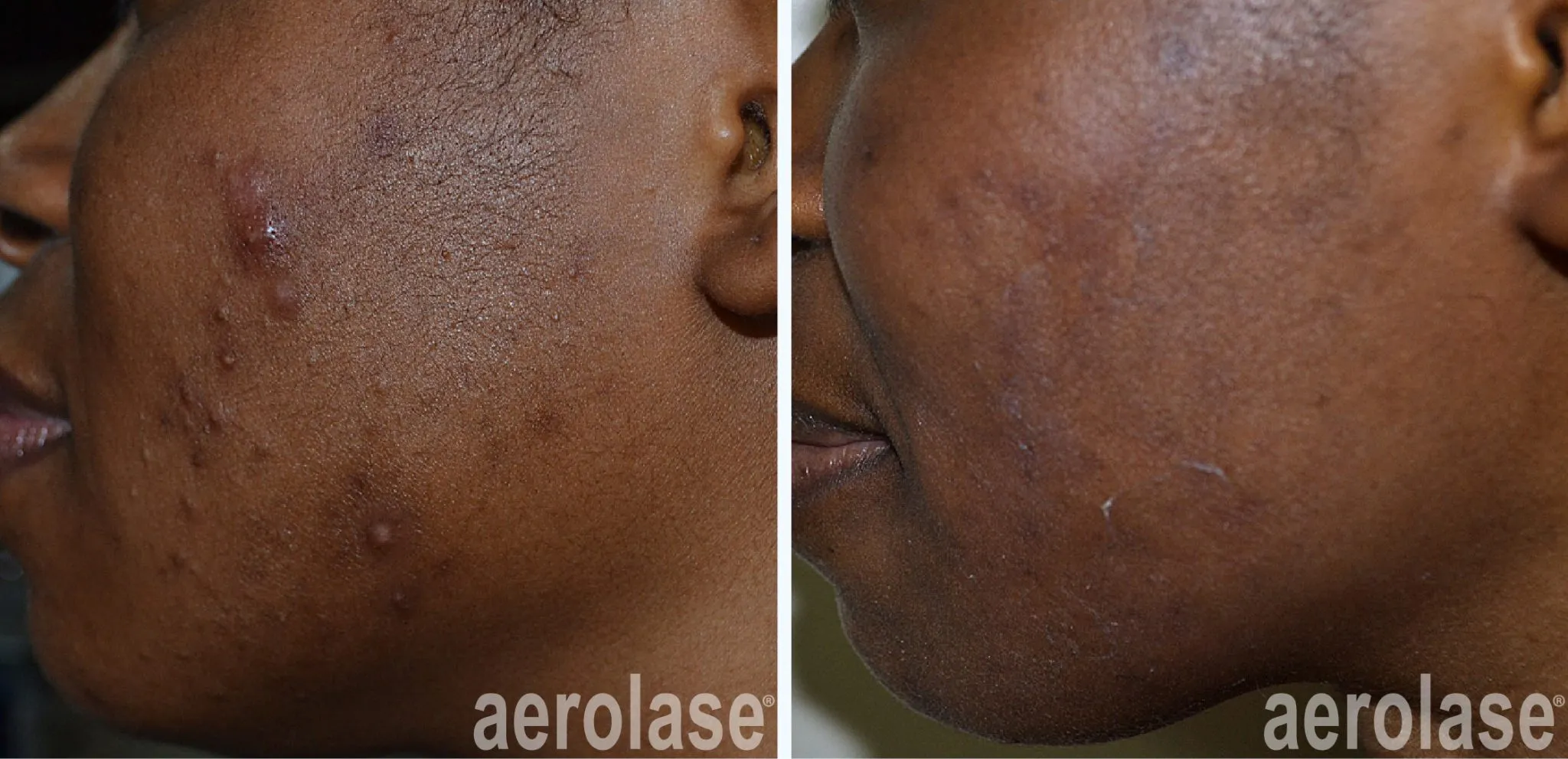 acne-cheeks-awudu-skinofcolor-before-and-after