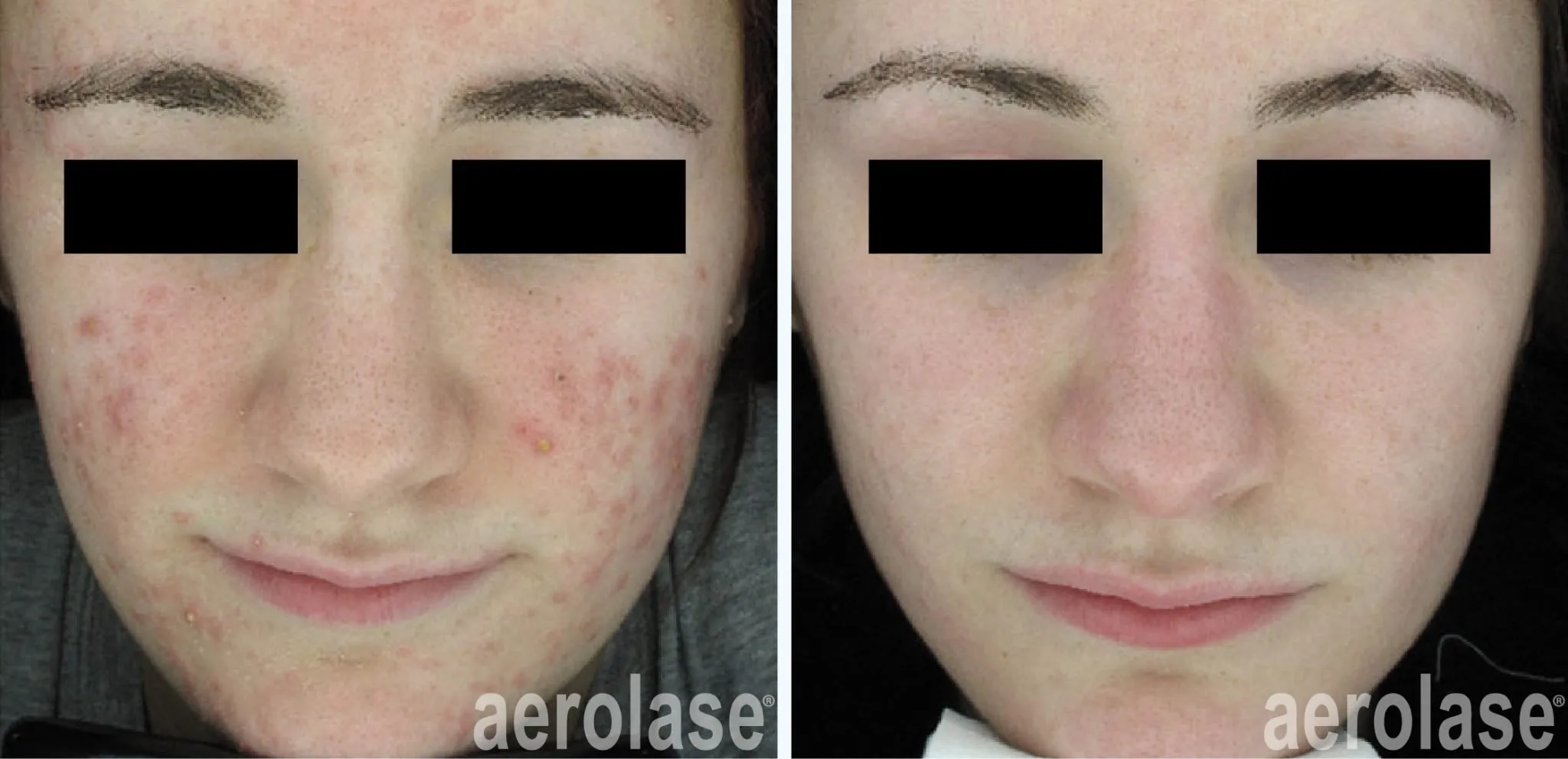 acne-cheeks-david-goldberg-before-and-after
