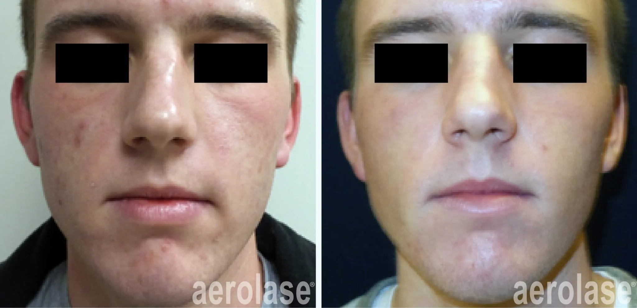 acne-cheeks-pinski-before-and-after-2