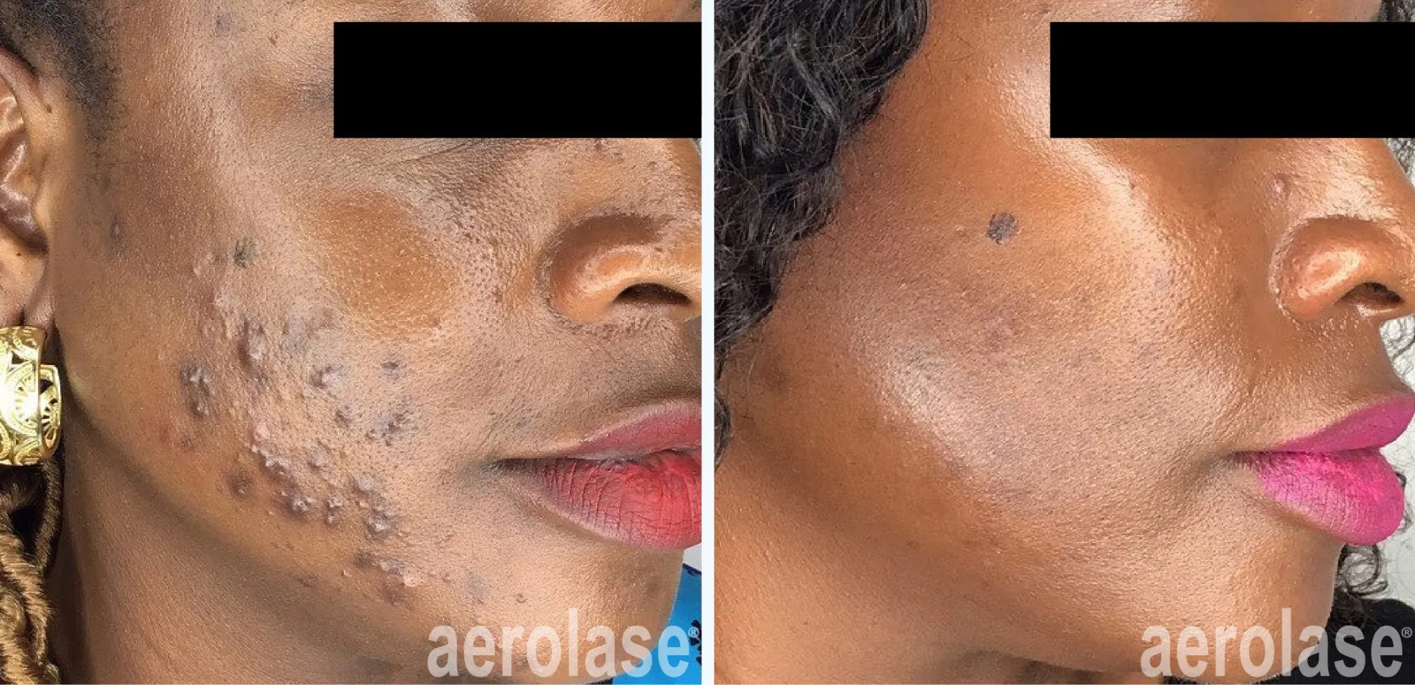 acne-cheeks-sholema-skinofcolor-before-and-after-2