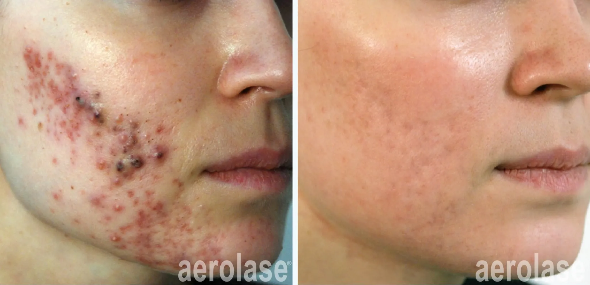 acne-cheeks-with-isotretinoin-michael-gold-before-and-after