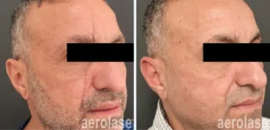 laser scar removal - scar removal using laser