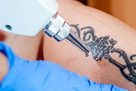 laser-tattoo-removal-course