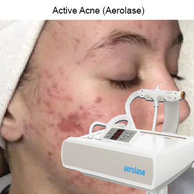 Treating Acne Scars with Laser: Acne Laser Treatment