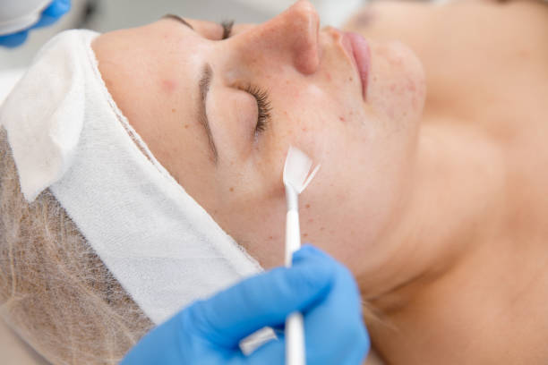 chemical peel hyperpigmentation