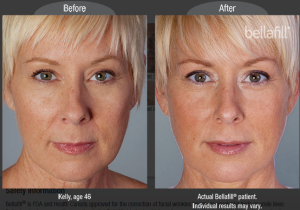 Dermal Fillers Nasolabial Folds