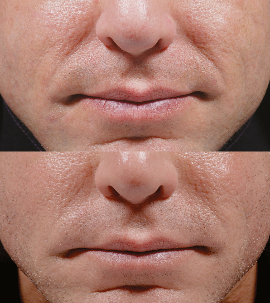 dermal filler nasolabial folds