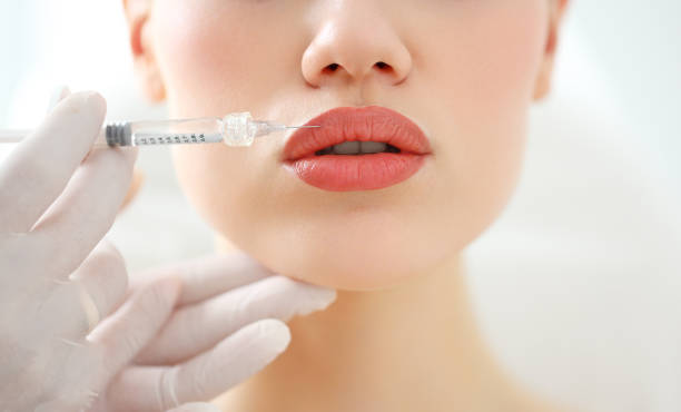 lip fillers - lip filler