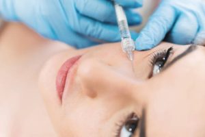 Face wreakles filling with hyaluronic acid fillers.